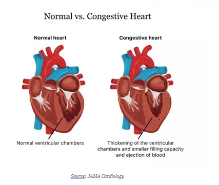 Gagal Jantung: Kenali Pompa Lemah Dan Kunci Hidup Sehat Jantung