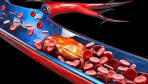 Solusi Cerdas Hiperlipidemia Gejala Dan Pilihan Herbal